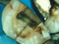 亀裂が入った歯の写真